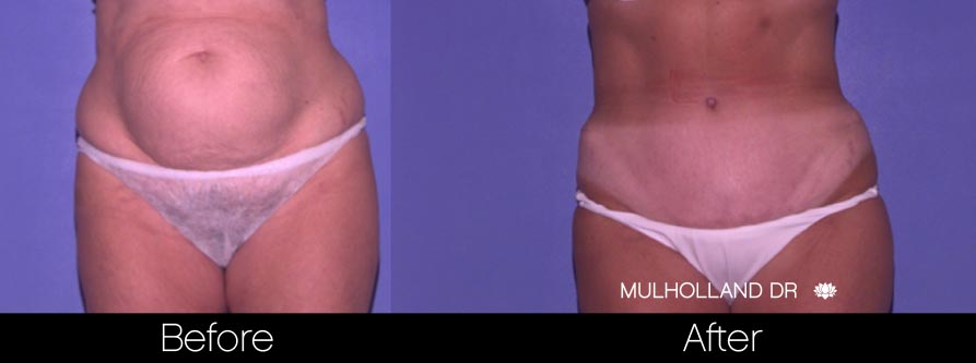 Tummy Tuck -Before and After Gallery - Patient Photo 32