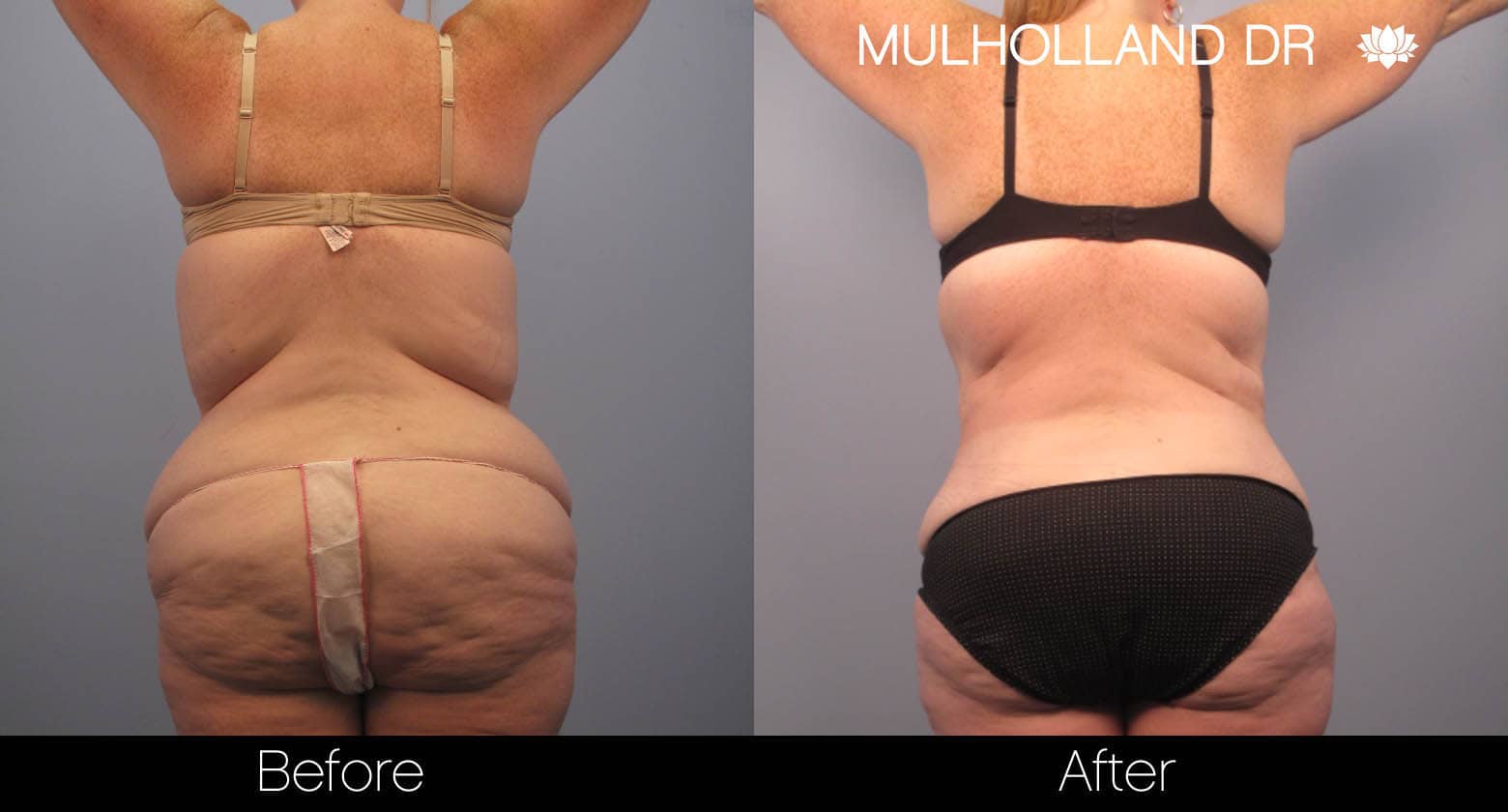 Tummy Tuck -Before and After Gallery - Patient Photo 4