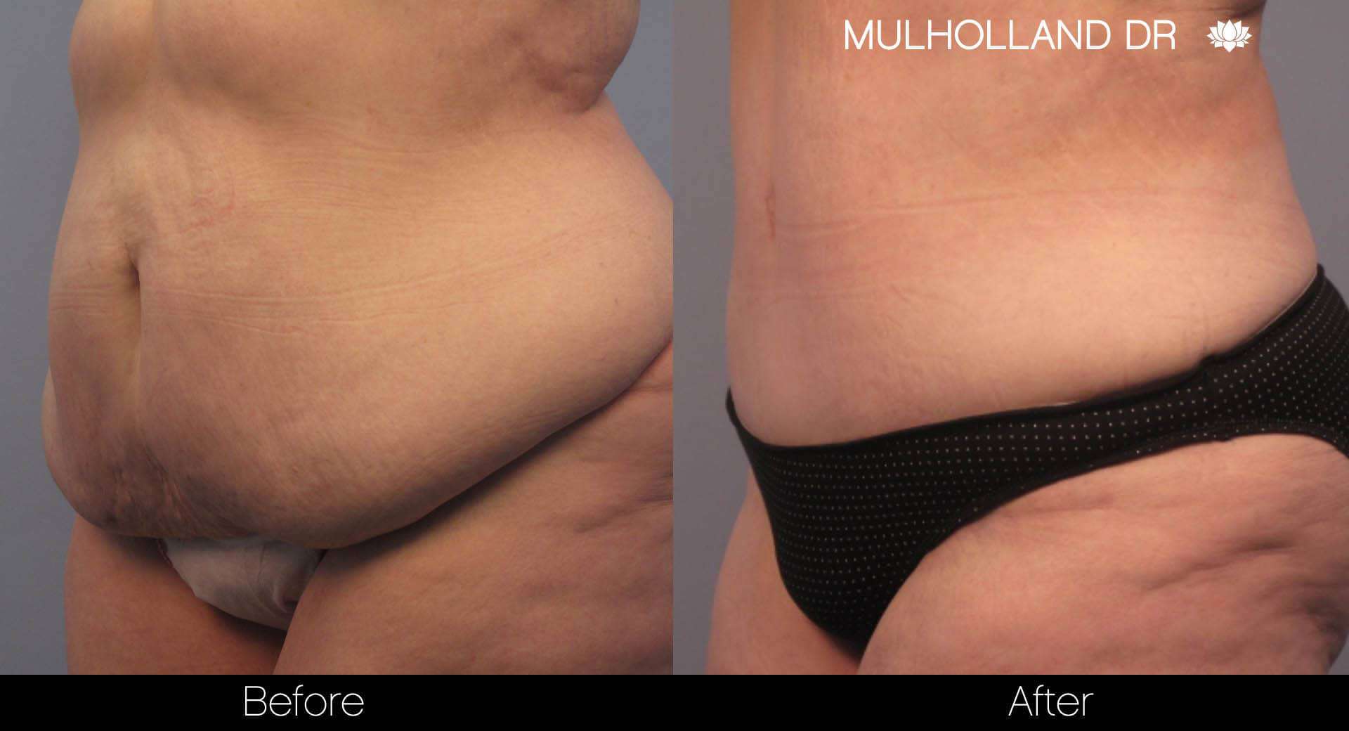Tummy Tuck -Before and After Gallery - Patient Photo 6