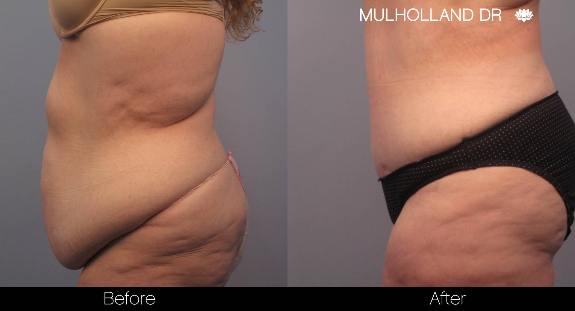 Tummy Tuck -Before and After Gallery - Patient Photo 7