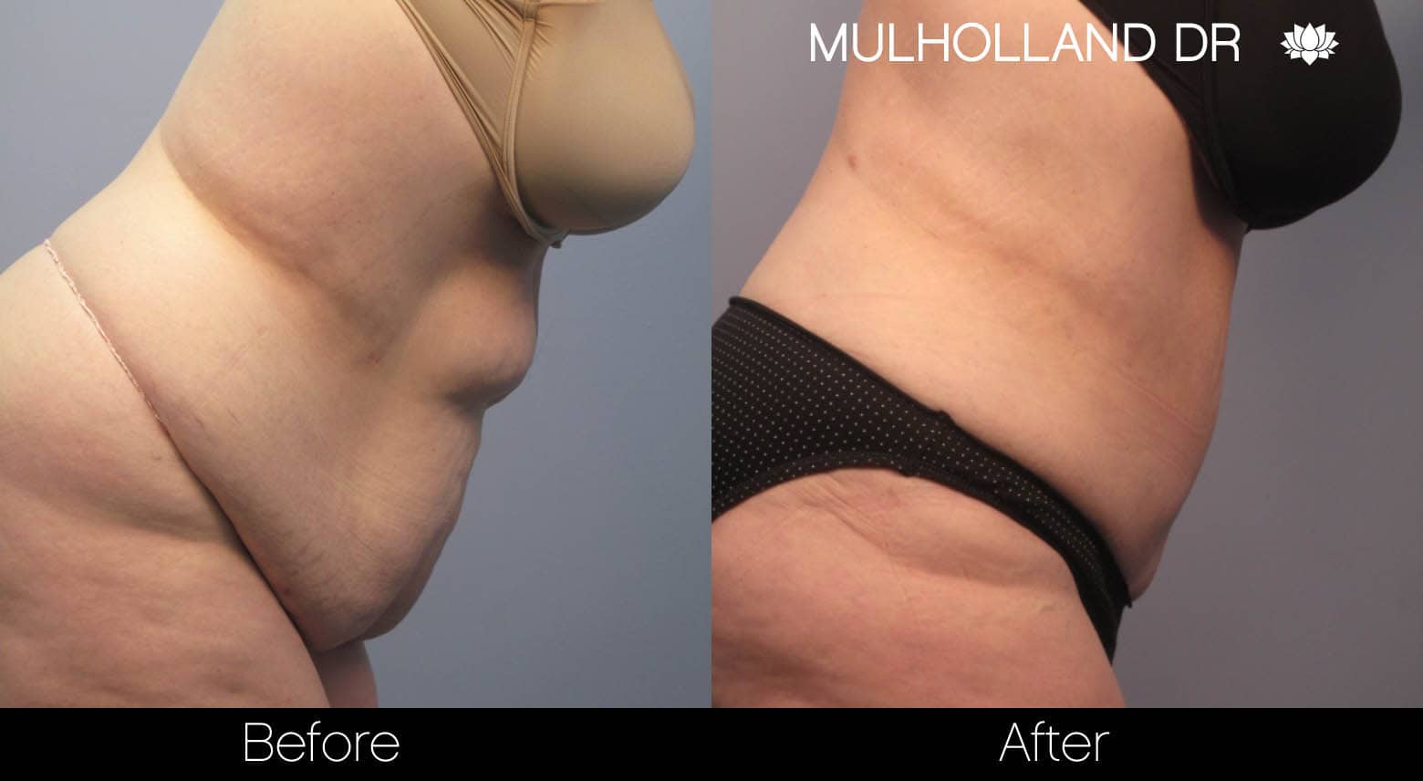 Tummy Tuck -Before and After Gallery - Patient Photo 8