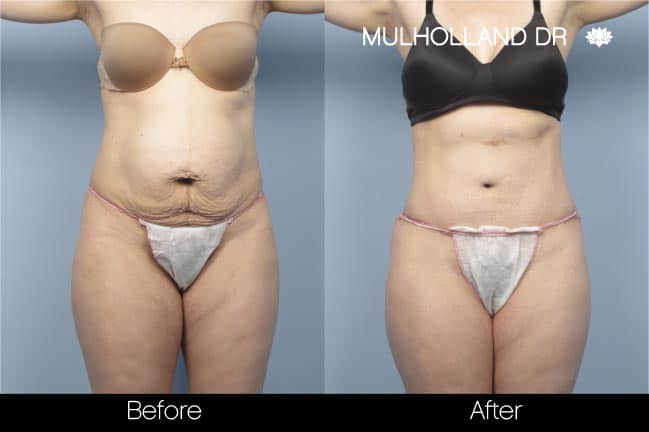 Tummy Tuck -Before and After Gallery - Patient Photo 9