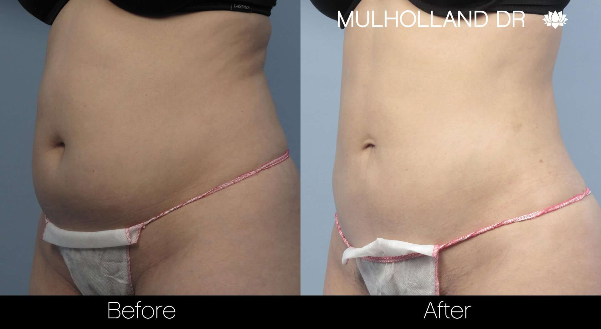 Vaser Liposuction - Before and After Gallery - Patient Photo 6