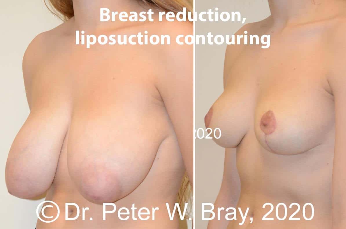 Breast Reduction - Before and After Gallery – Photo 10