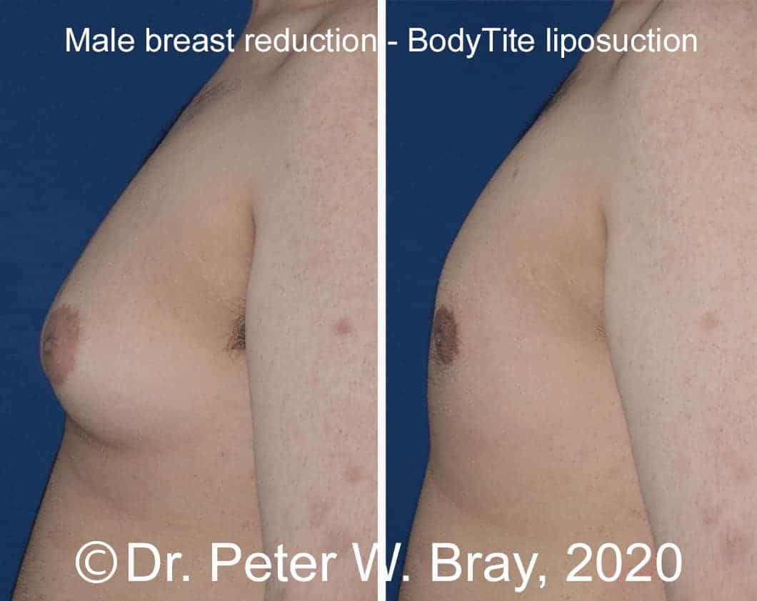 Male Breast Reduction - Before and After Gallery – Photo 10