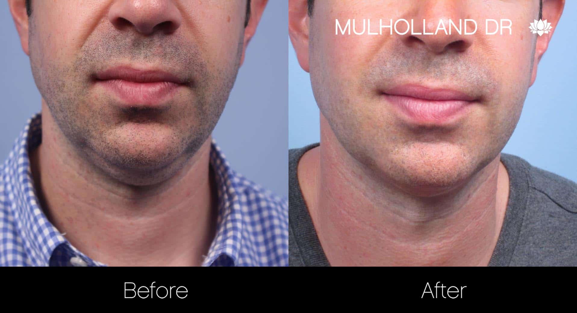 Male Double Chin - Before and After Gallery – Photo 10