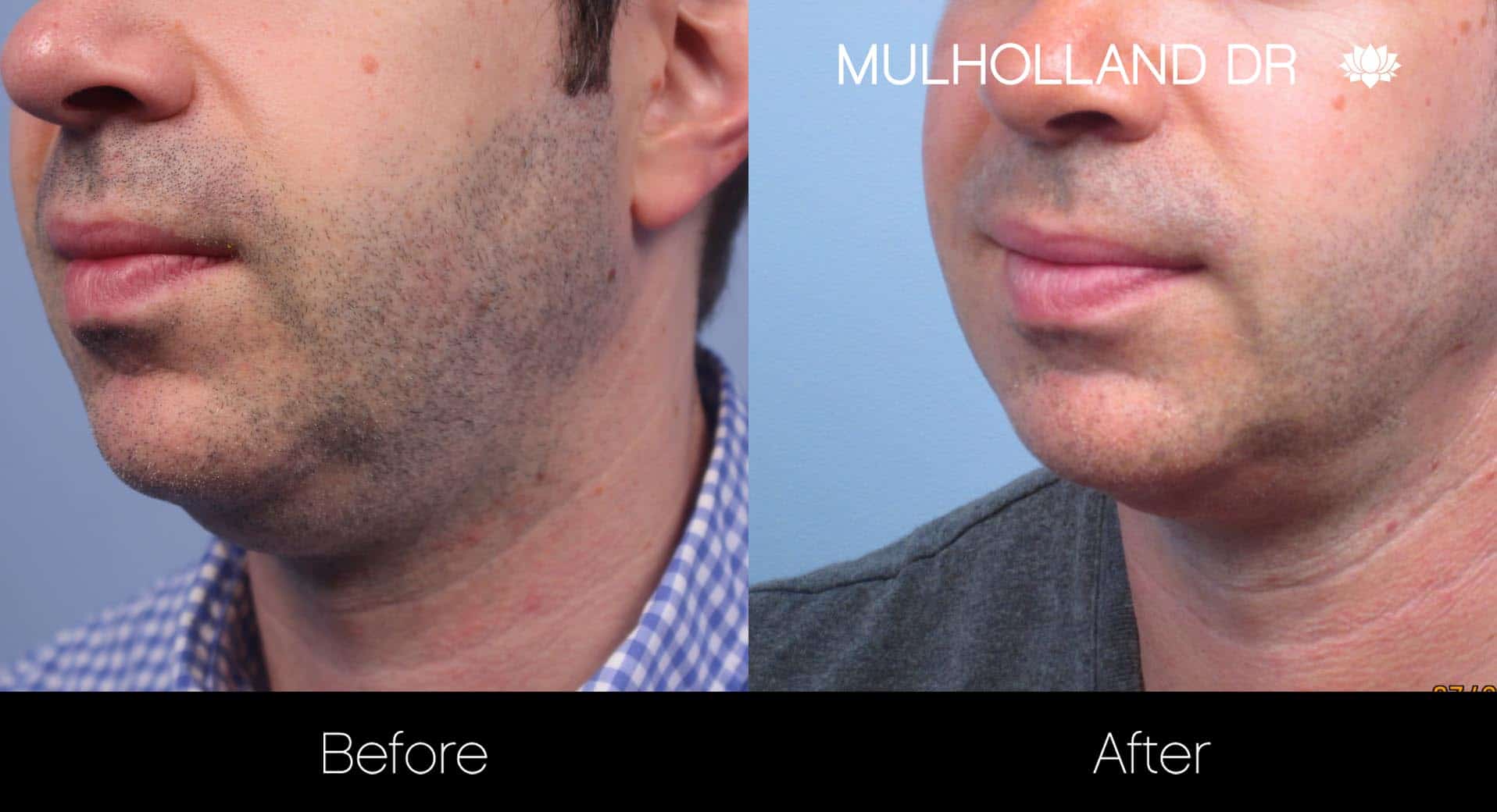 Male Double Chin - Before and After Gallery – Photo 11