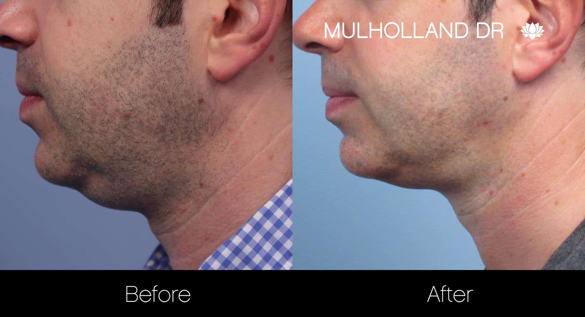 Male Double Chin - Before and After Gallery – Photo 12
