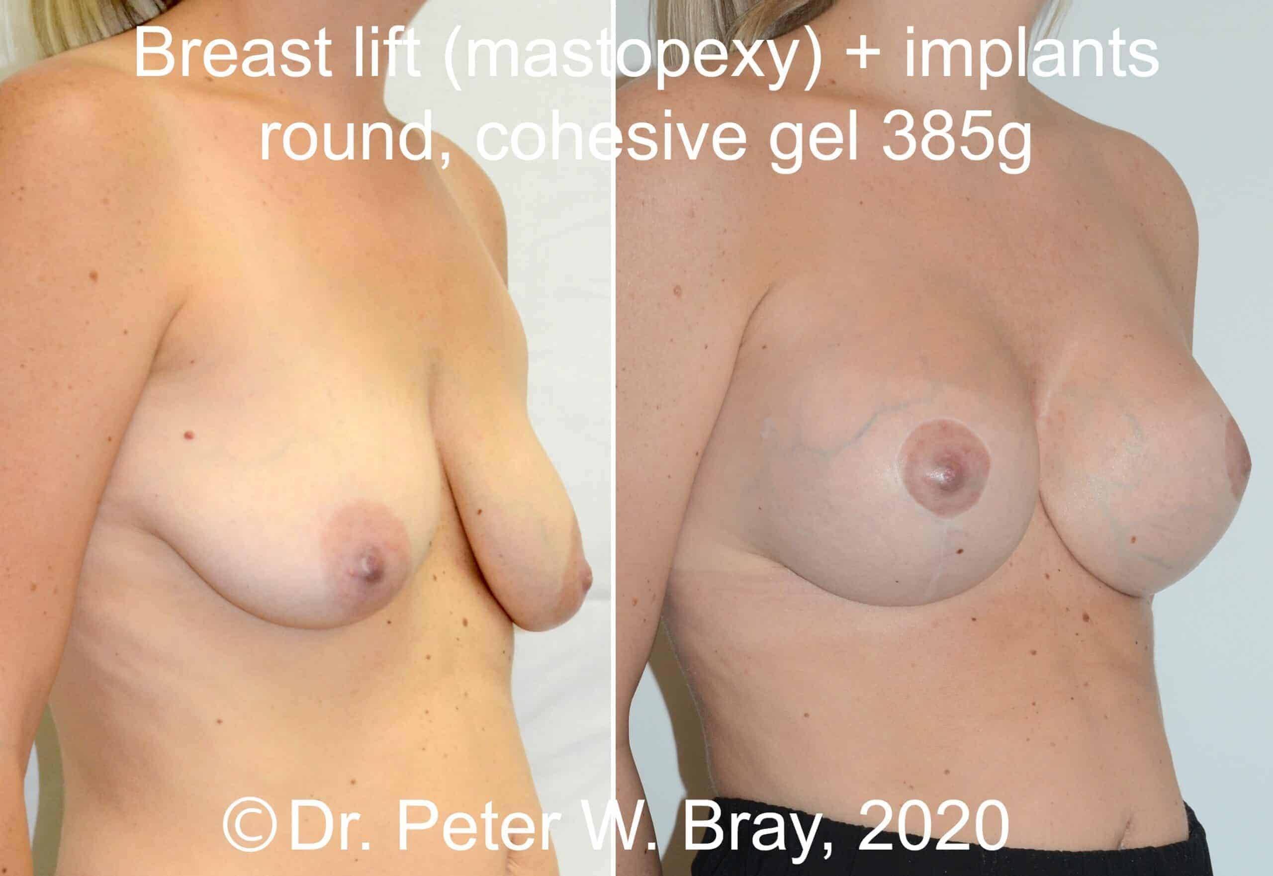 Breast Lift - Before and After Gallery – Photo 1