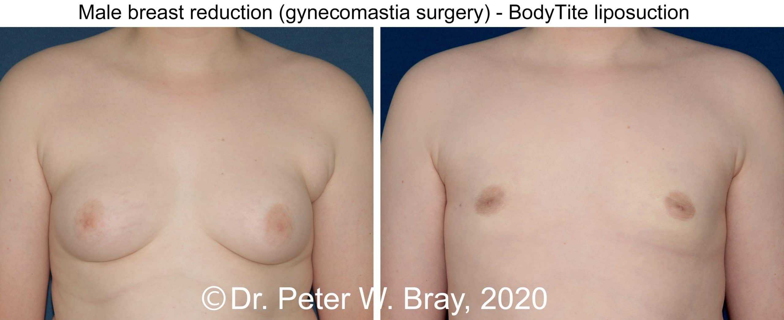 Male Breast Reduction - Before and After Gallery – Photo 2