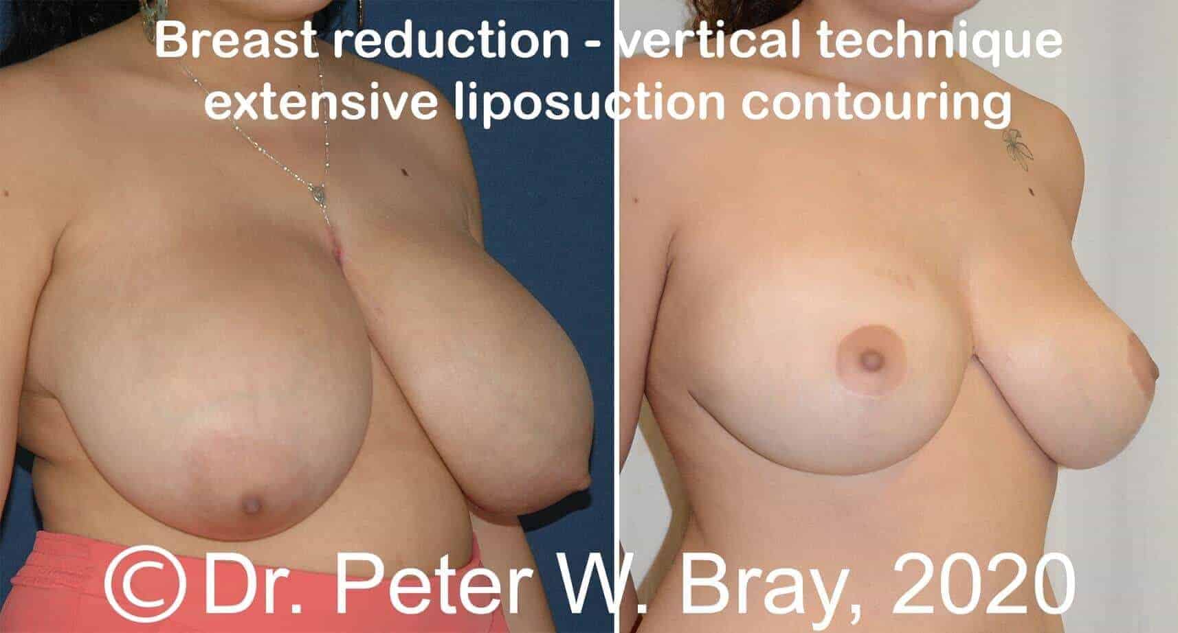 Breast Reduction - Before and After Gallery – Photo 4