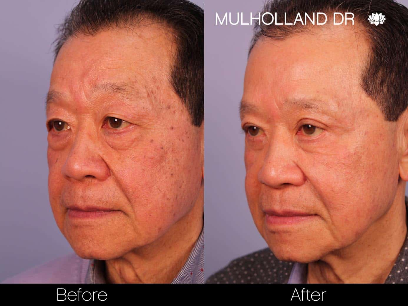 Male Blepharoplasty - Before and After Gallery – Photo 3