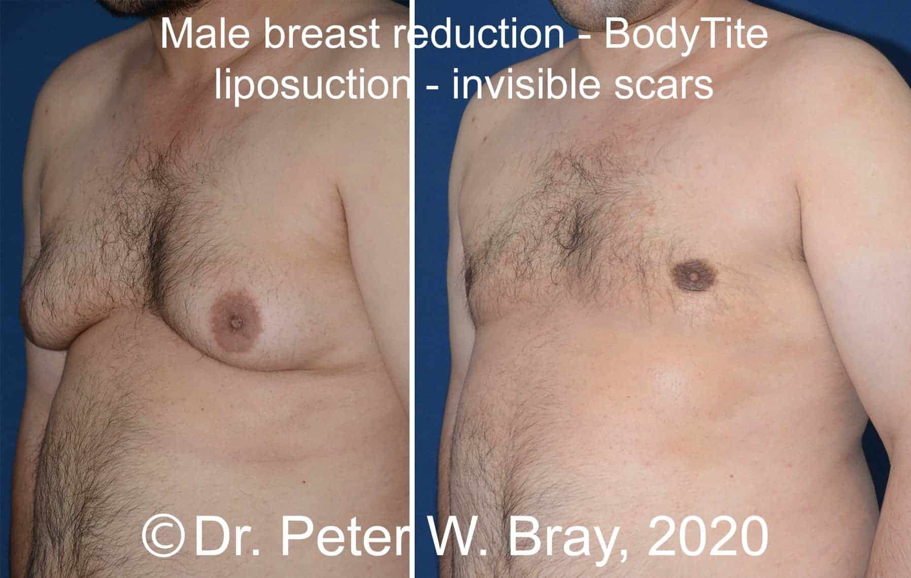 Male Breast Reduction - Before and After Gallery – Photo 3