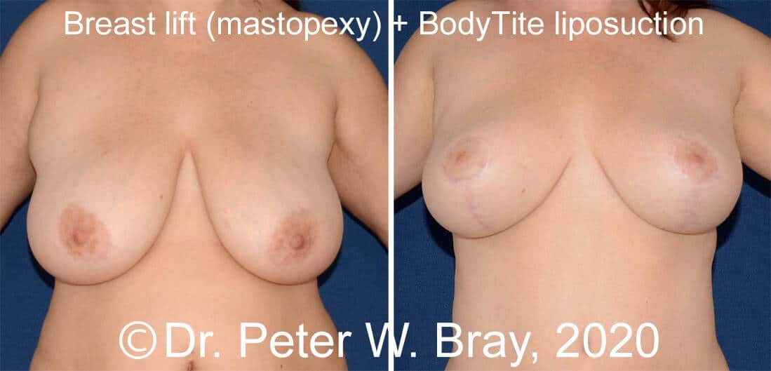 Breast Reduction - Before and After Gallery – Photo 5