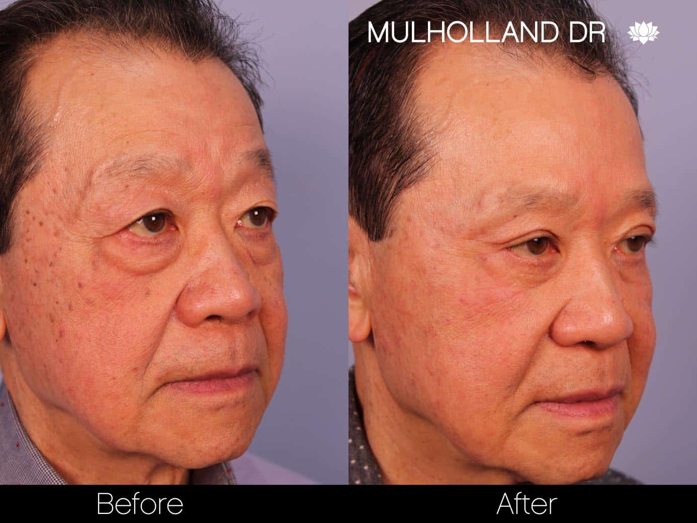 Male Blepharoplasty - Before and After Gallery – Photo 4