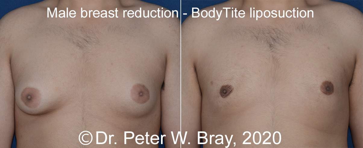 Male Breast Reduction - Before and After Gallery – Photo 4