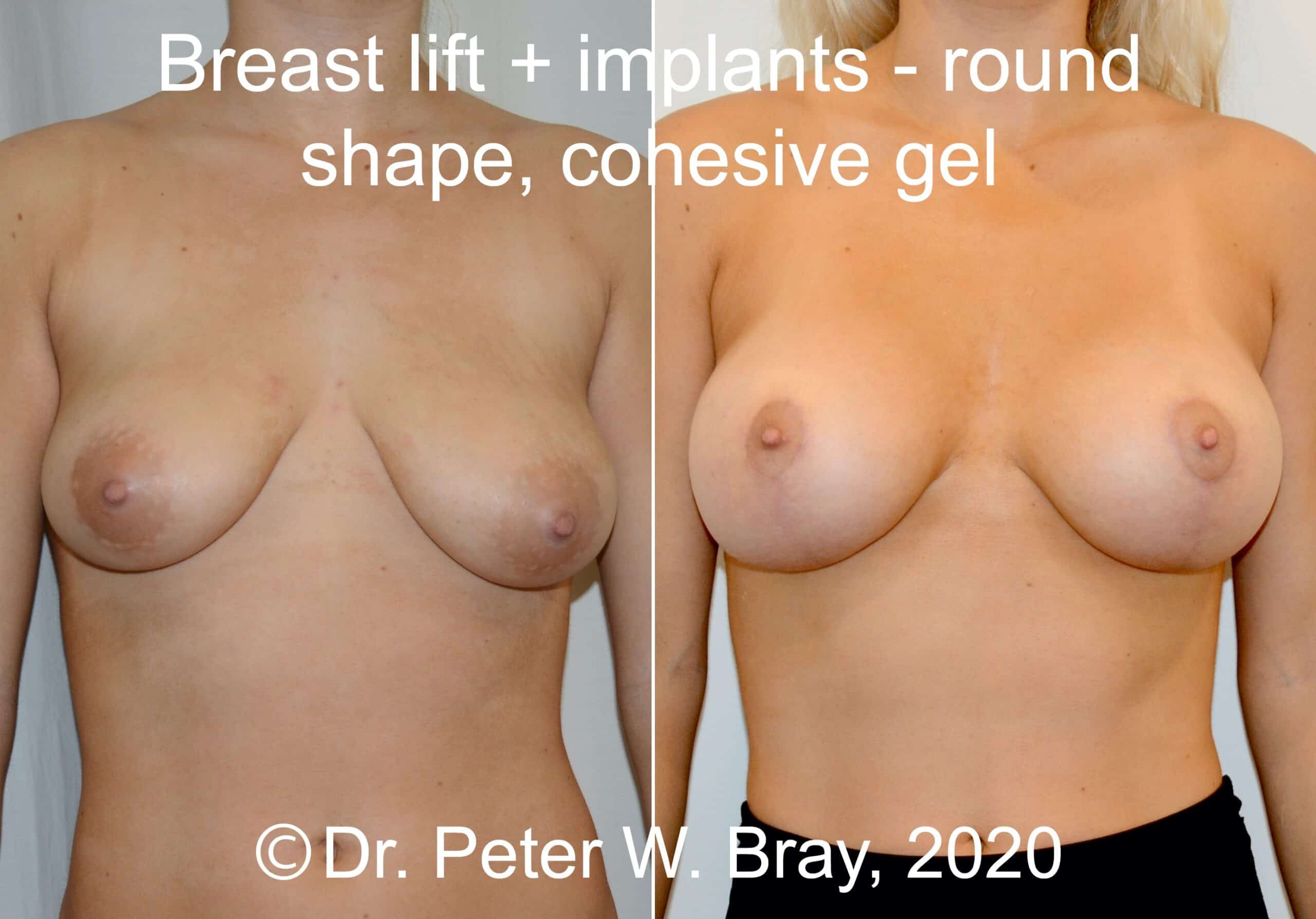 Breast Lift - Before and After Gallery – Photo 5