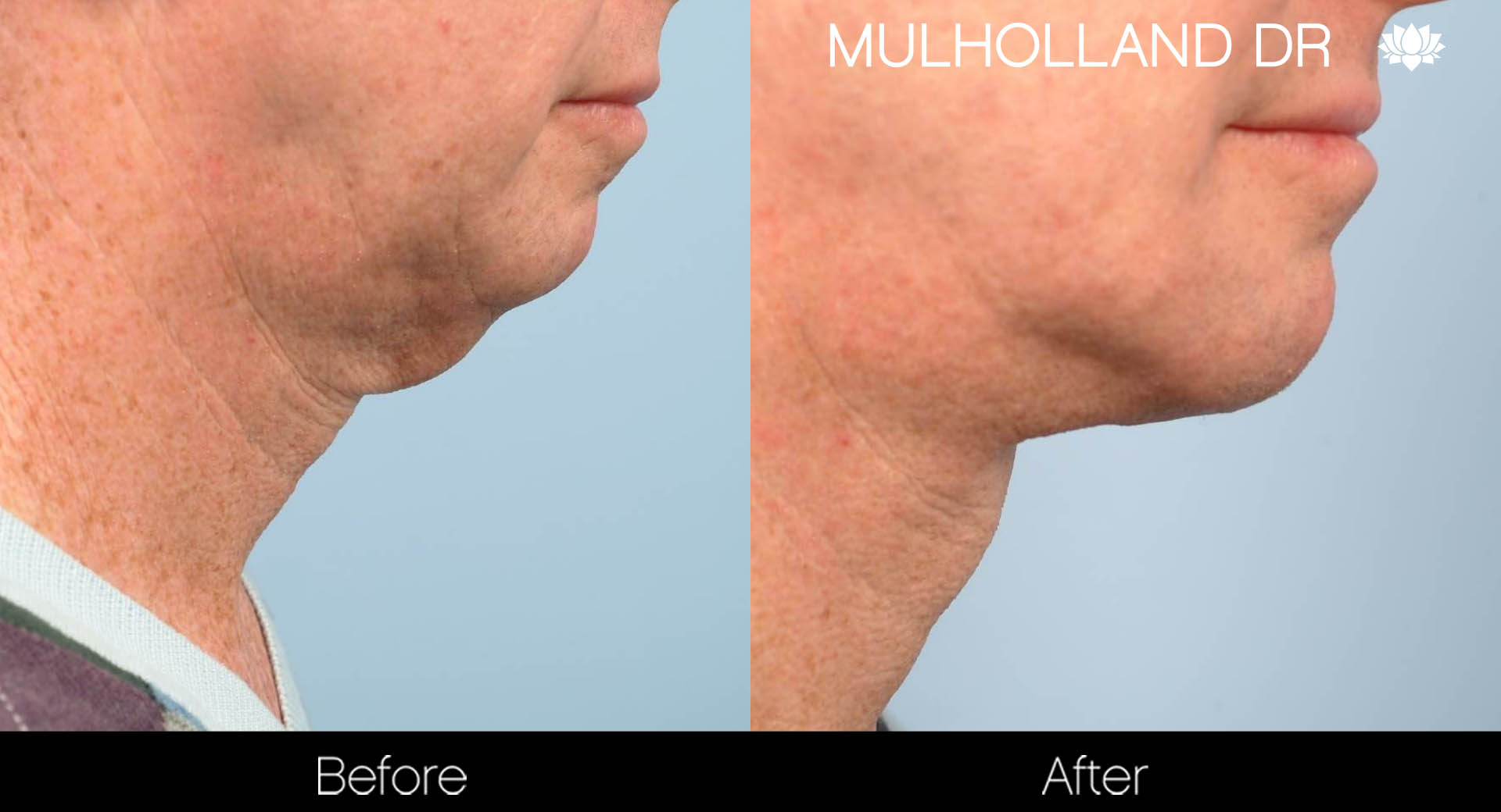 Male Double Chin - Before and After Gallery – Photo 5