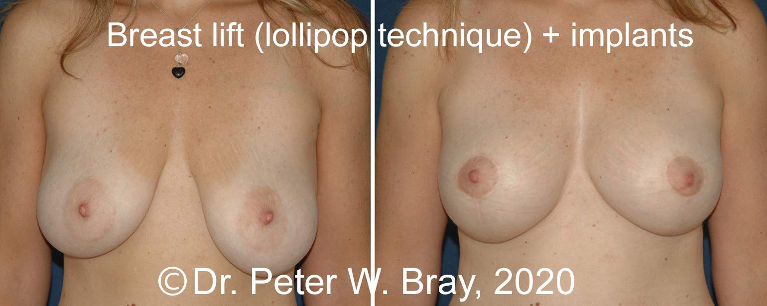 Breast Lift - Before and After Gallery – Photo 6