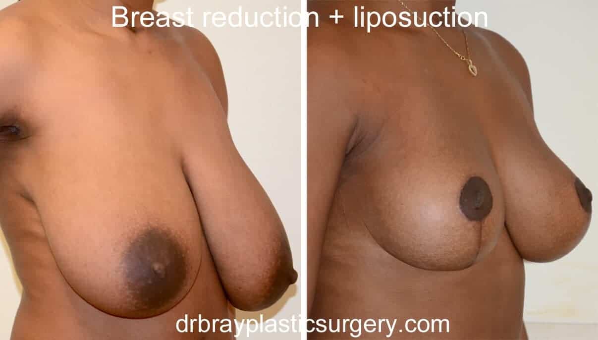 Breast Reduction - Before and After Gallery – Photo 3
