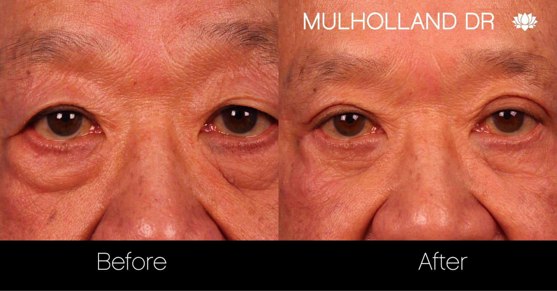 Male Blepharoplasty - Before and After Gallery – Photo 6