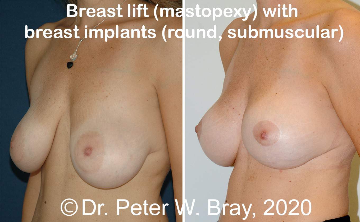 Breast Lift - Before and After Gallery – Photo 7