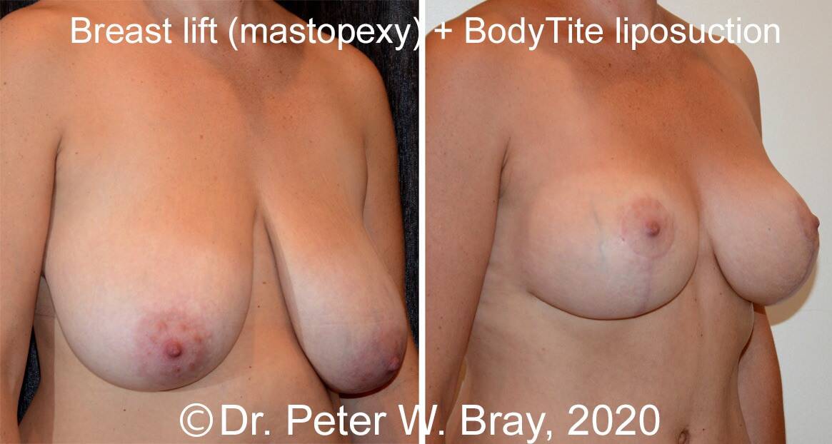 Breast Reduction - Before and After Gallery – Photo 7