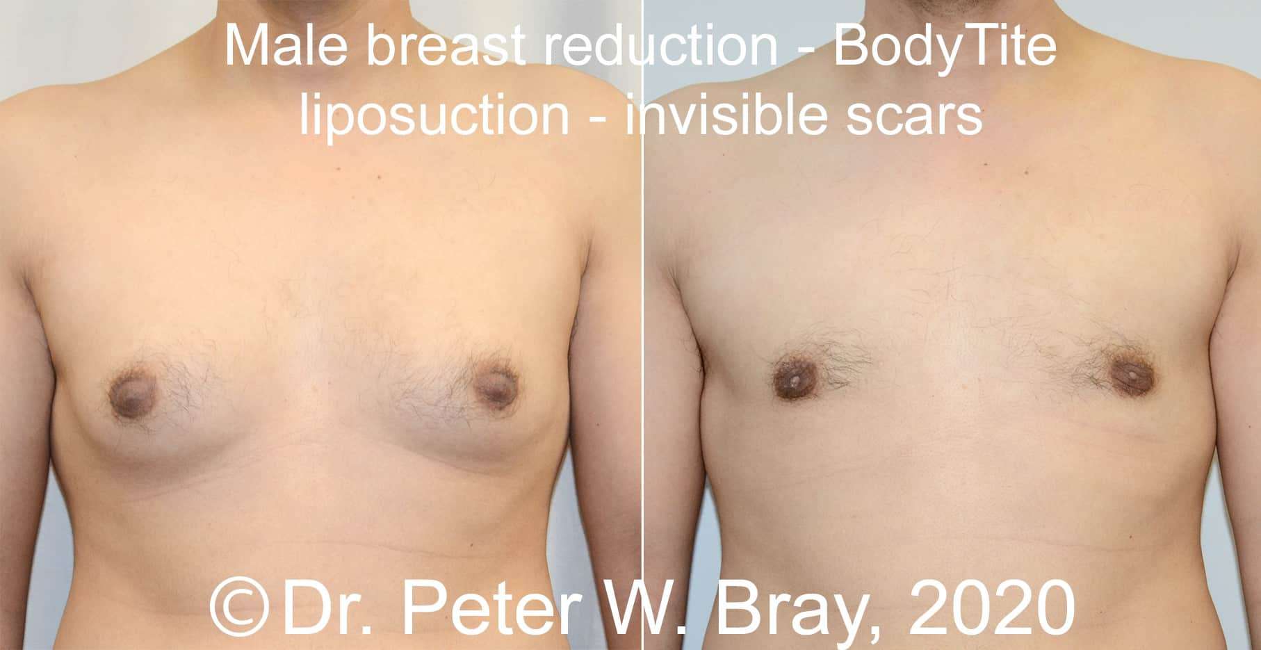 Male Breast Reduction - Before and After Gallery – Photo 7