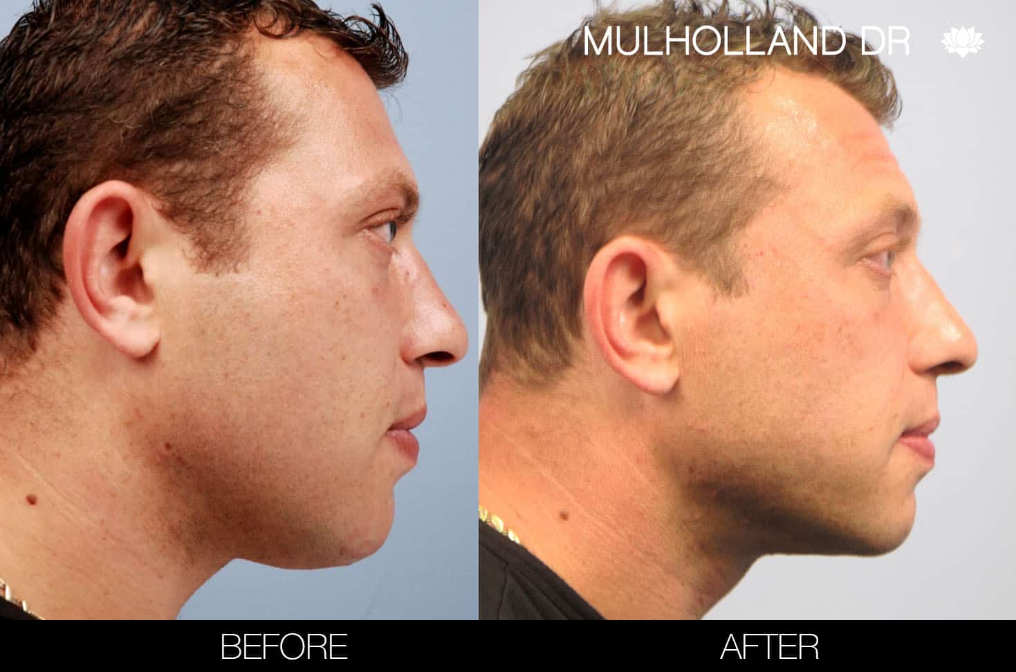 Male Double Chin - Before and After Gallery – Photo 7