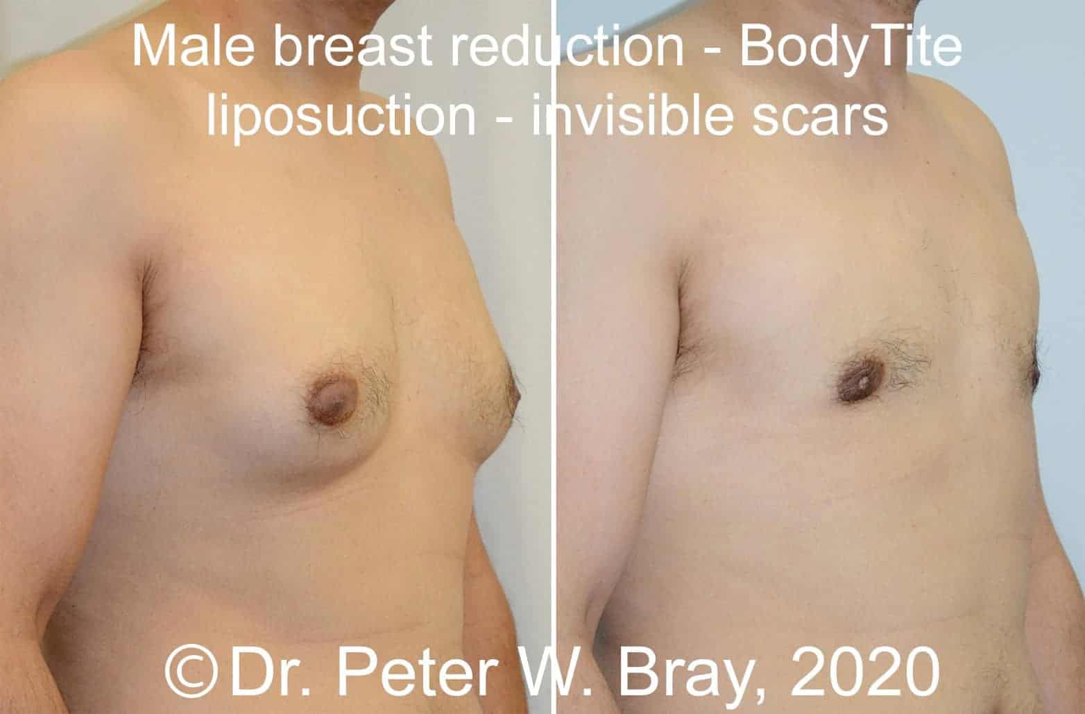 Male Breast Reduction - Before and After Gallery – Photo 8