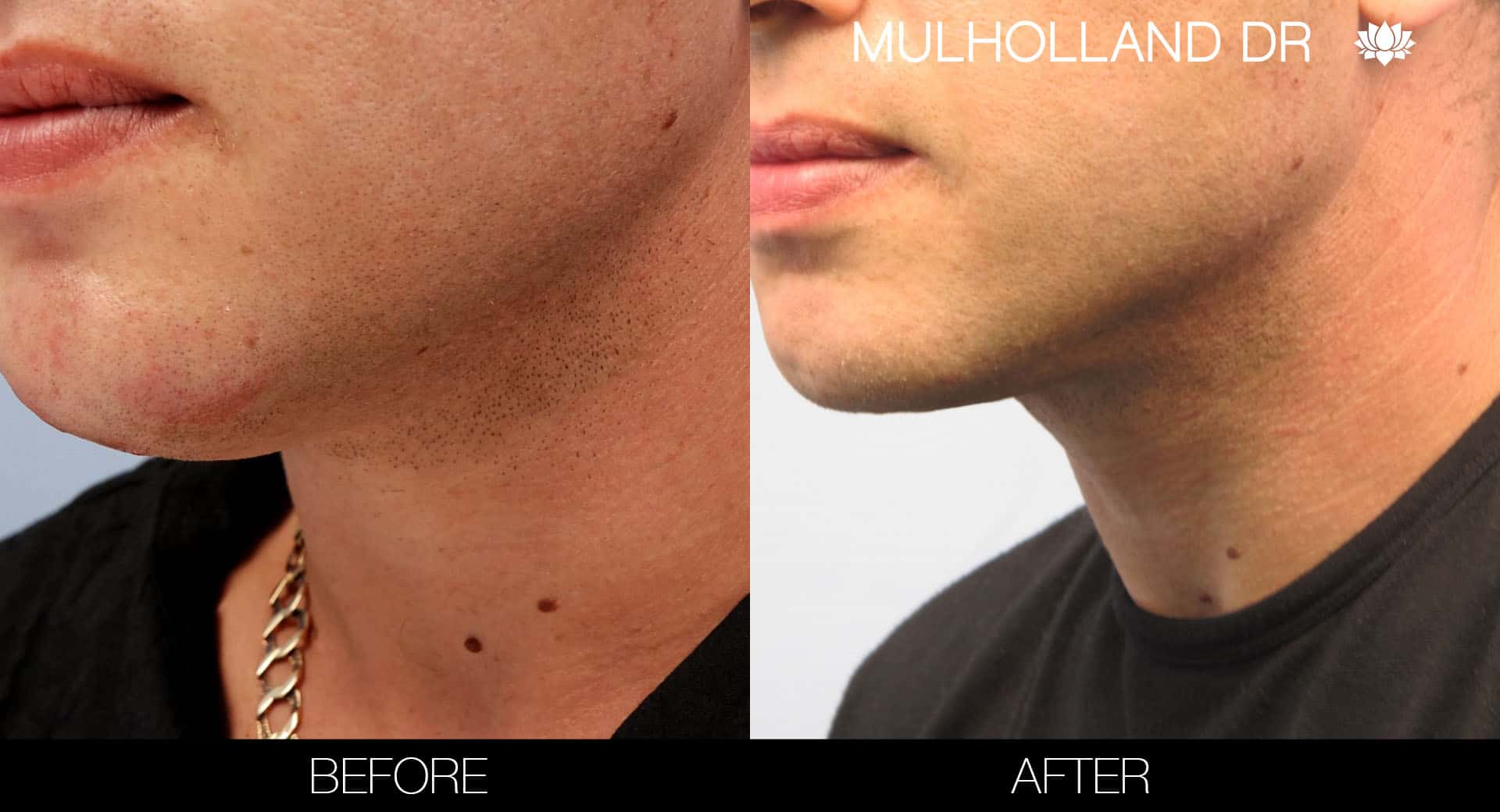 Male Double Chin - Before and After Gallery – Photo 8