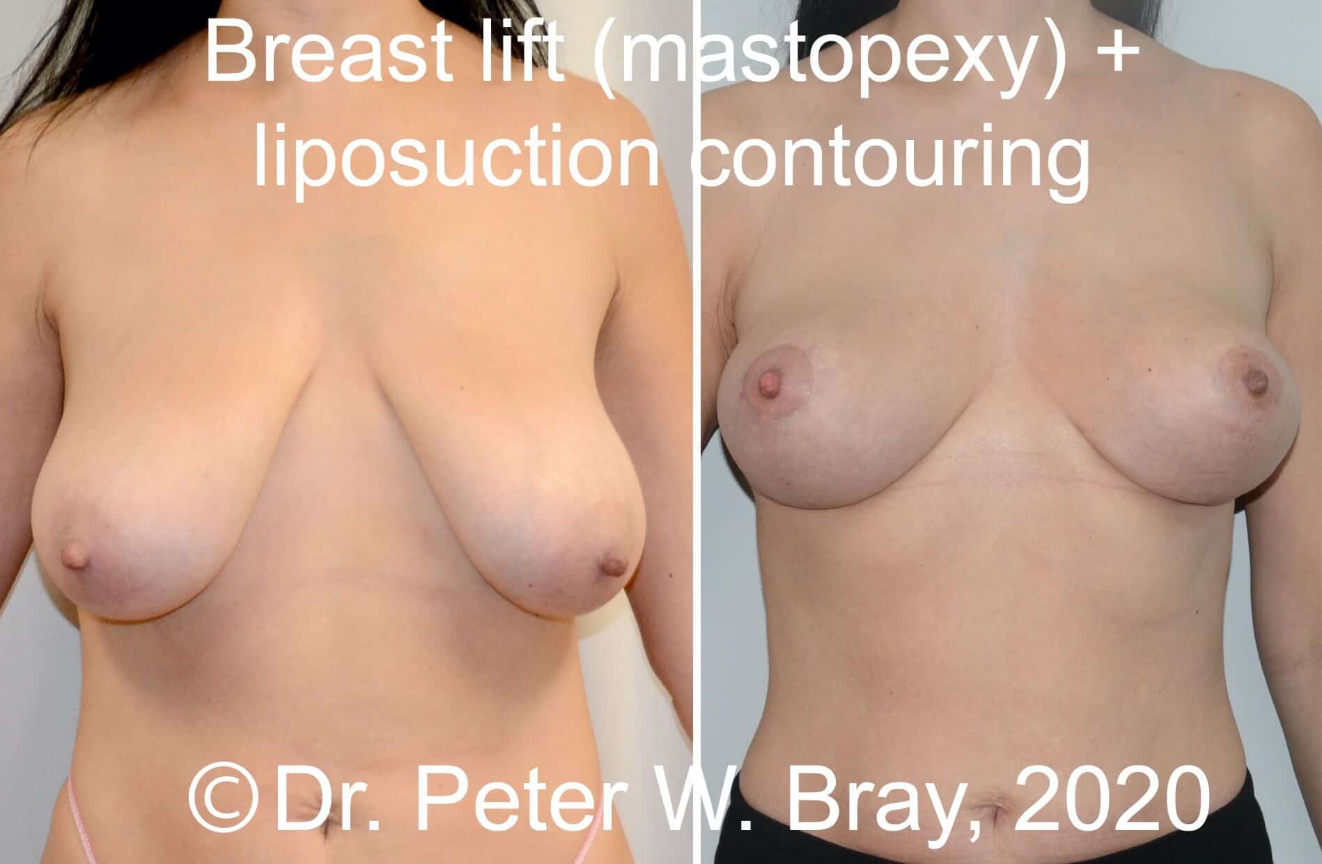 Breast Reduction - Before and After Gallery – Photo 9