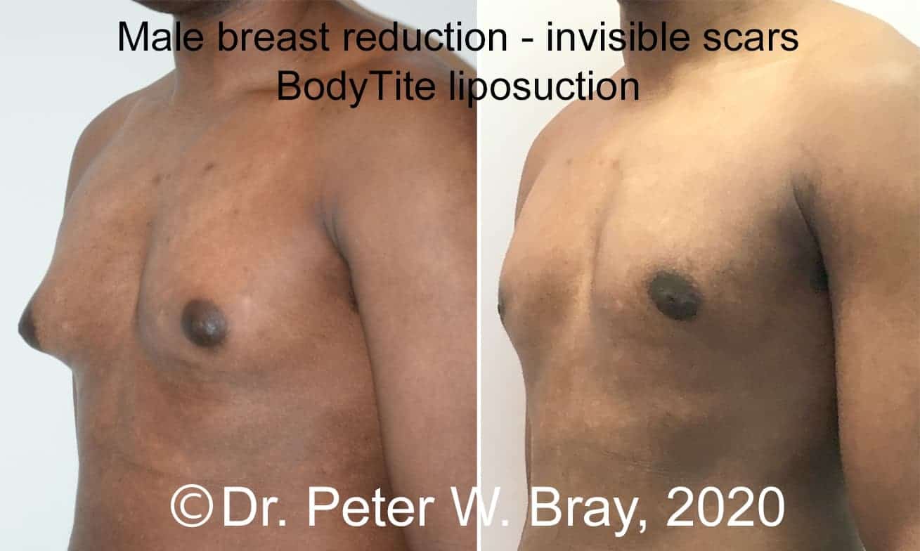 Male Breast Reduction - Before and After Gallery – Photo 9