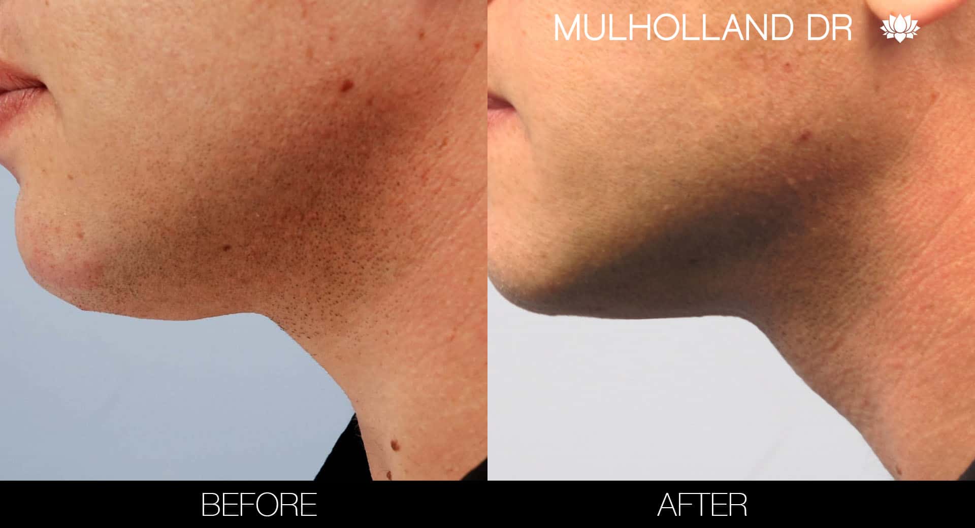Male Double Chin - Before and After Gallery – Photo 9