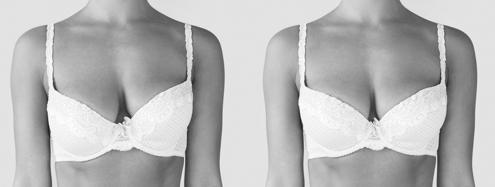 Can Breast Augmentation Fix Uneven Breasts?