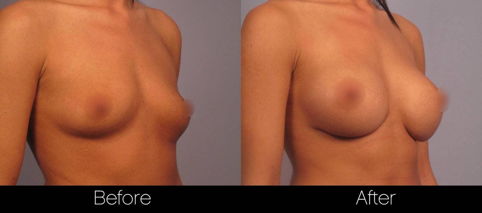 Before and after photos showcasing the results of a breast augmentation procedure in Toronto. The left image depicts a woman's chest before surgery with smaller breast size and the right image shows increased fullness and size after augmentation, with improved breast contour.