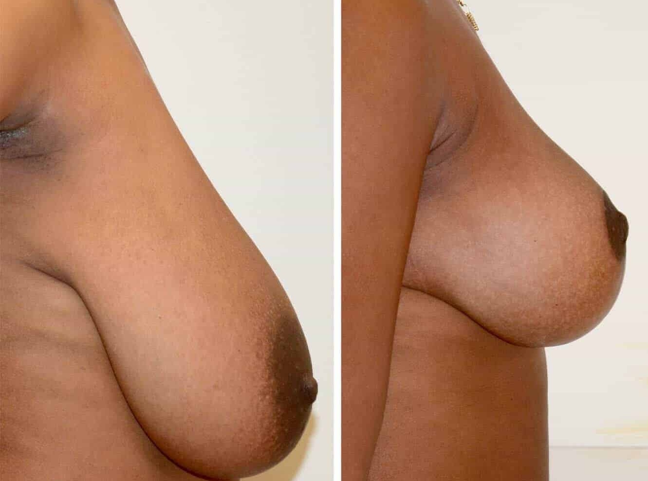 Side profile comparison of breast reduction and liposuction in Toronto. The 'Before' image shows a significantly larger breast with a downward pointing nipple, indicative of a heavy, pendulous breast. The 'After' image reveals a much smaller, lifted breast with the nipple repositioned to a more central location on the breast, creating a more proportionate silhouette.