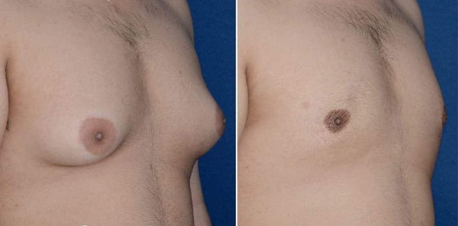 Before and after photos of a male undergoing breast reduction surgery.