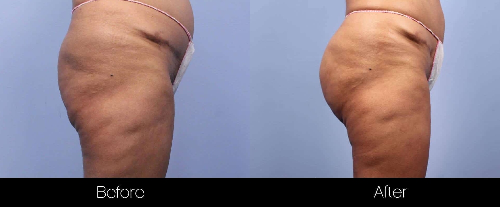 Before and after photo of Brazilian butt lift procedure.