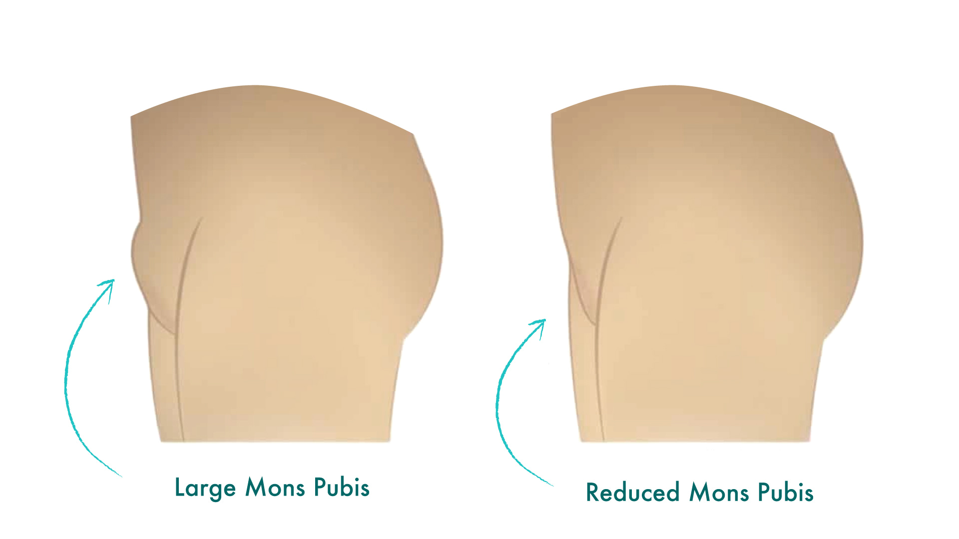 Side-by-side comparison of 'Before and After' monsplasty illustrations.