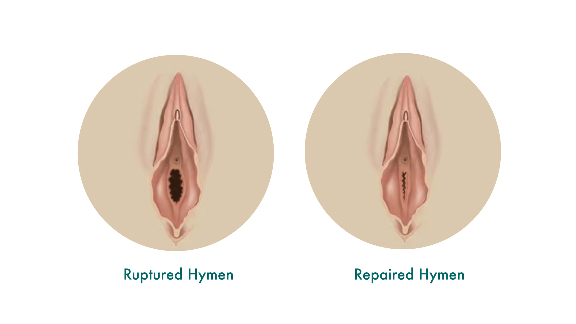 Side-by-side medical illustrations depicting 'Before and After' views of a hymenoplasty procedure.