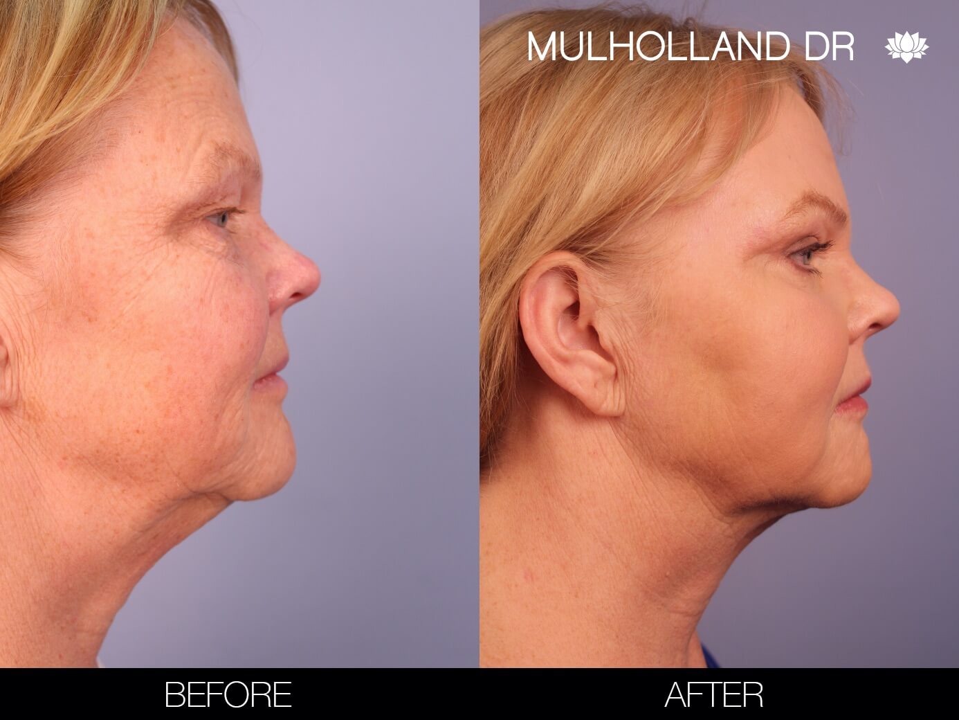 Before and after photo of a thread lift procedure in Toronto. Image 9