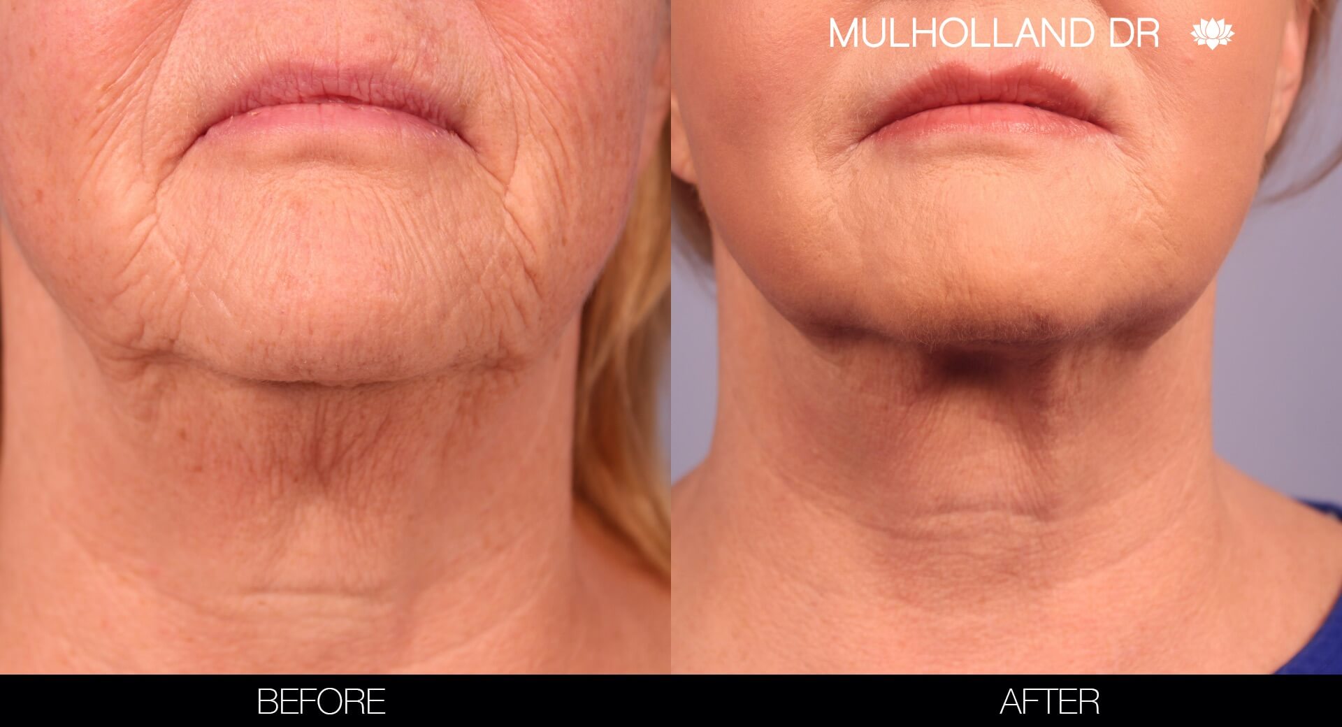 Before and after photo of a thread lift procedure in Toronto. Image 11