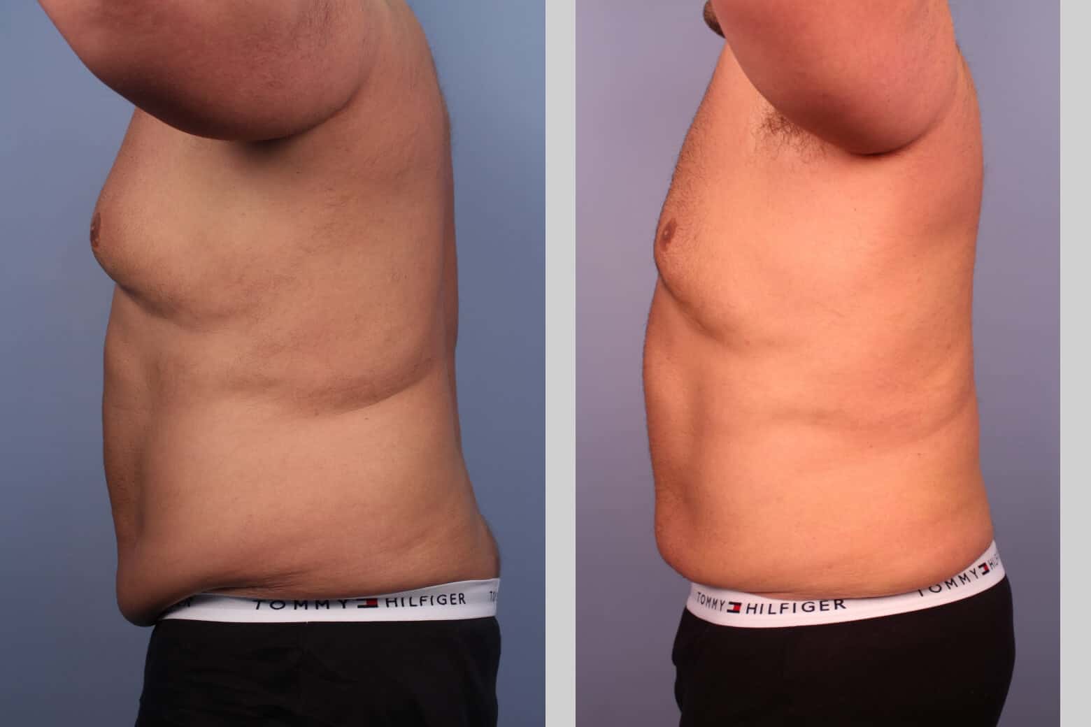 Before and after photo of Belt Lipectomy by a Toronto Plastic Surgeon. Image 41