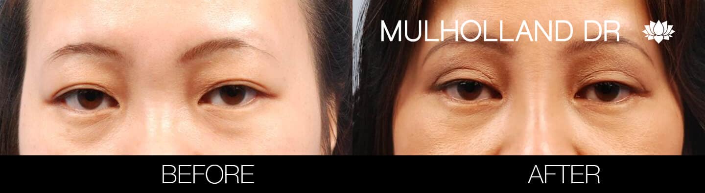 Double eyelid surgery before and after photo. Image 8