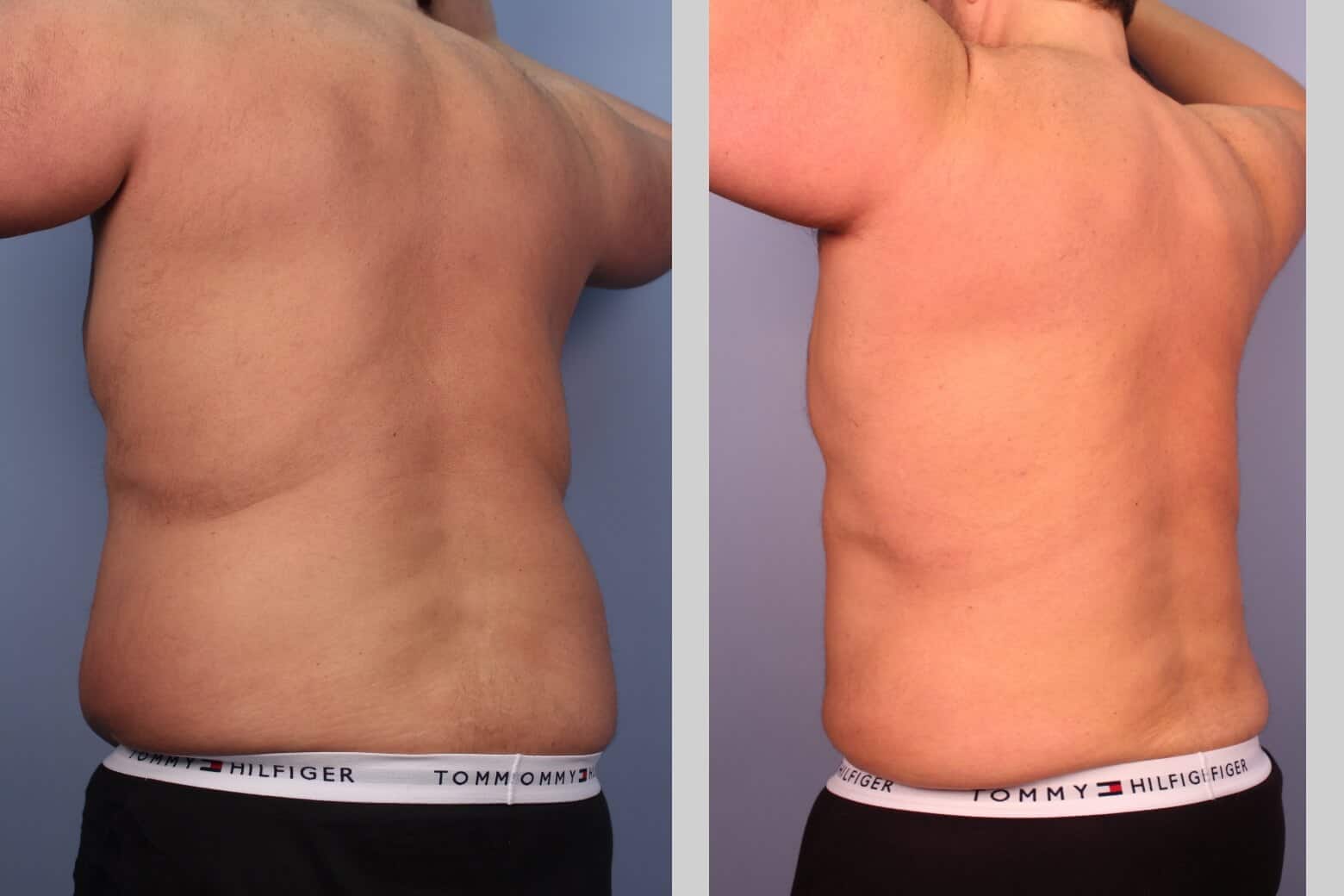 Before and after photo of Belt Lipectomy by a Toronto Plastic Surgeon. Image 40