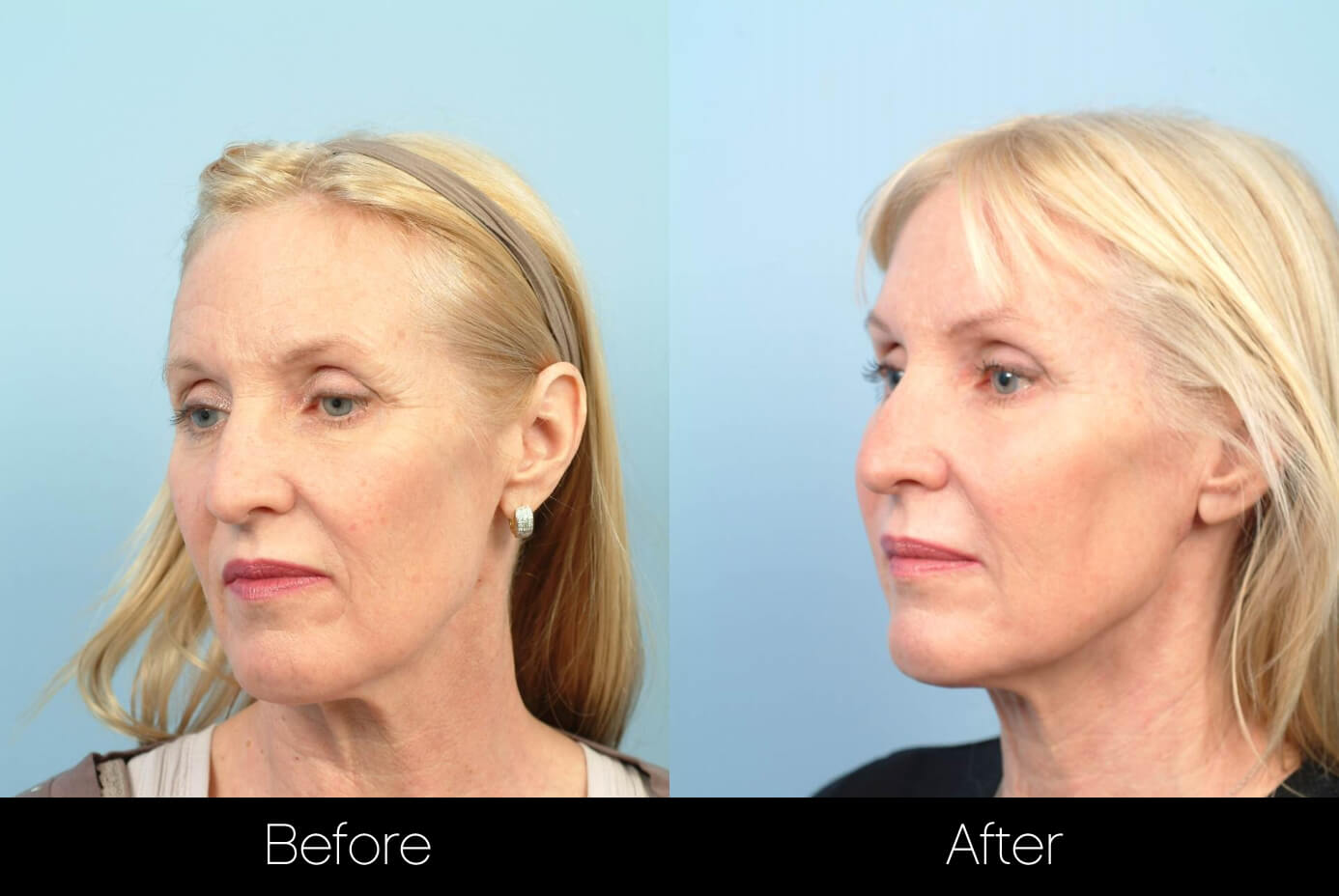 Before and after photo of a thread lift procedure in Toronto. Image 13