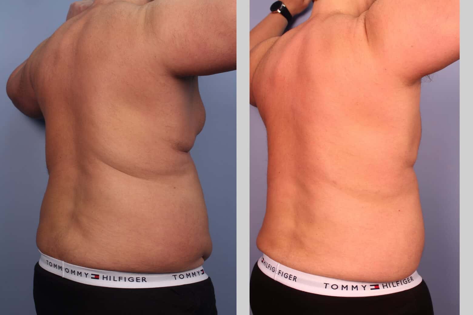 Before and after photo of Belt Lipectomy by a Toronto Plastic Surgeon. Image 39