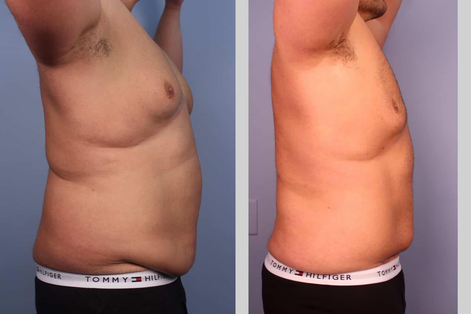 Before and after photo of Belt Lipectomy by a Toronto Plastic Surgeon. Image 38