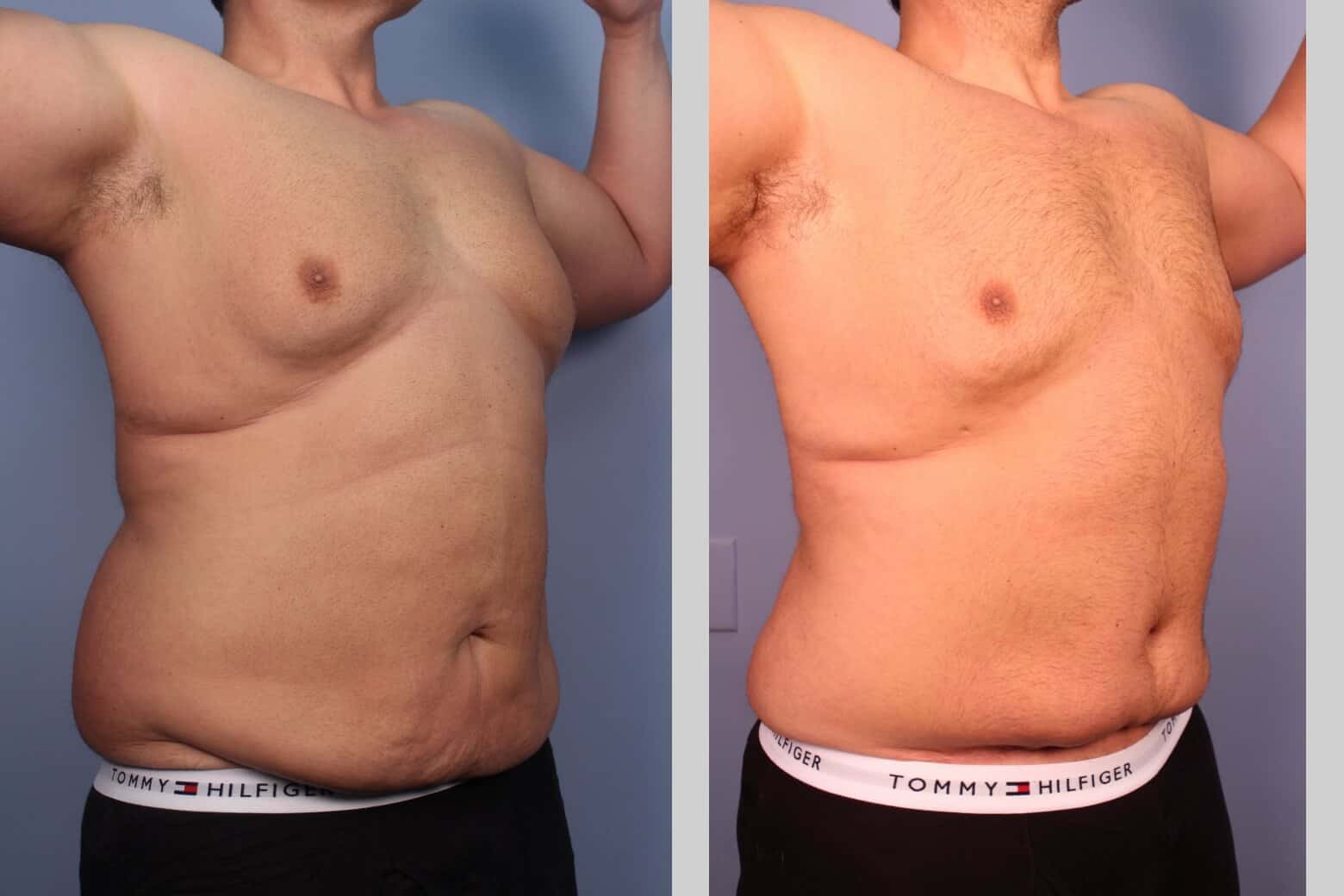 Before and after photo of Belt Lipectomy by a Toronto Plastic Surgeon. Image 37